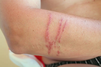 Scratched skin wounds